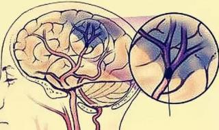 脑梗塞有什么后遗症 脑梗的后遗症是什么